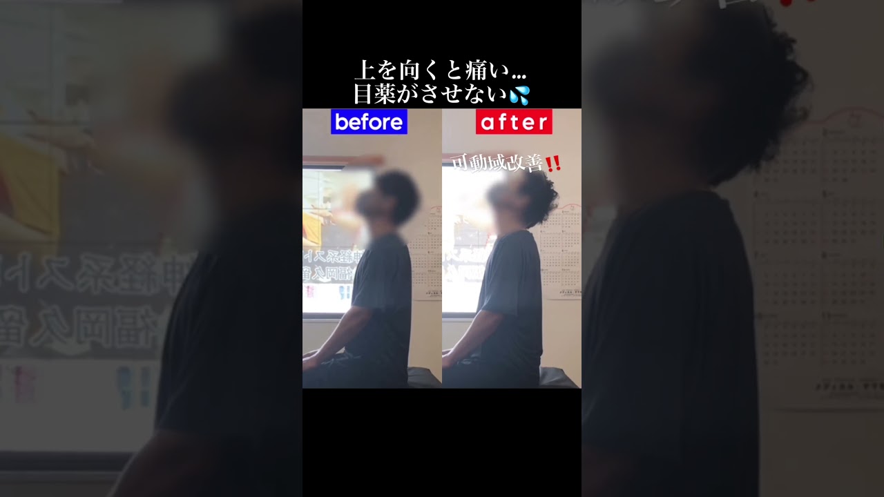 首を動かすたびに痺れる頚椎症|兼子ただし神経系ストレッチで改善解消!|大分県日田市からも来院の神経整体